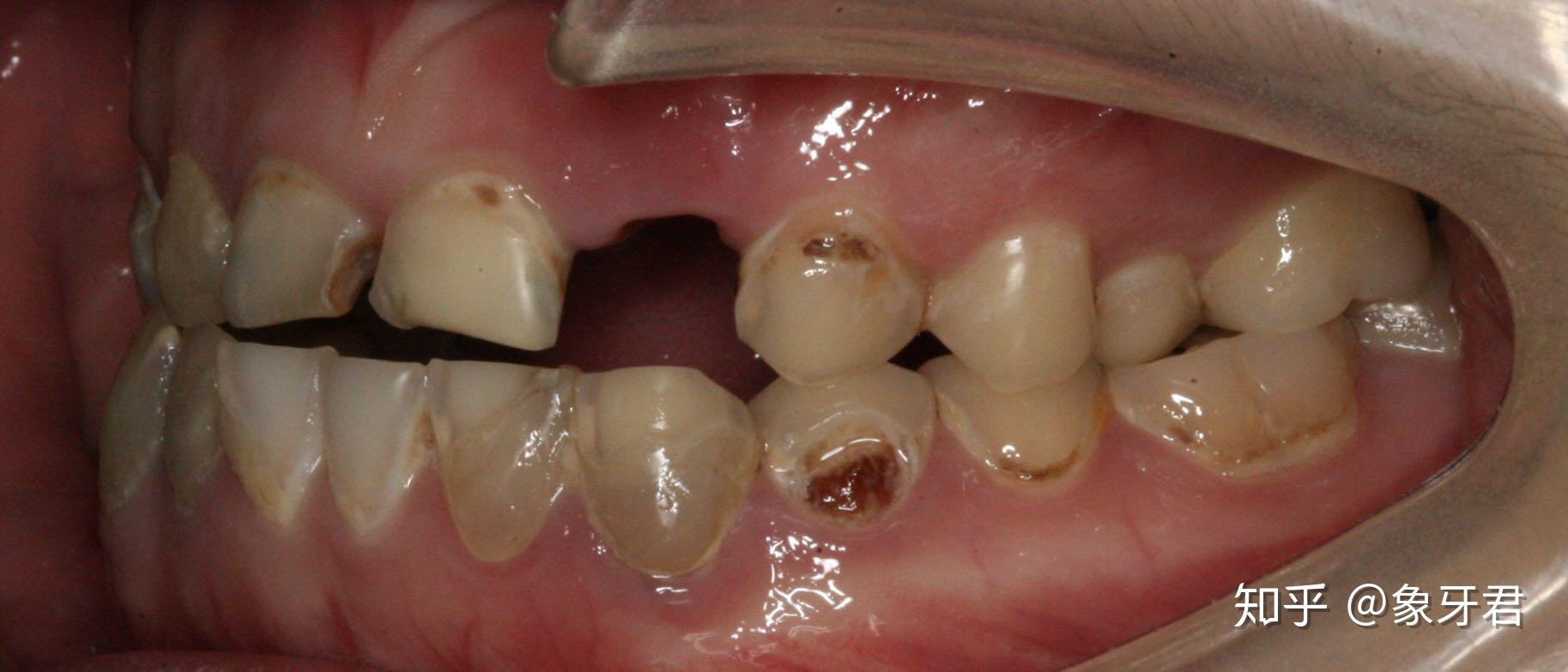 宝宝蛀牙早期症状图片,蛀牙初期图片 - 伤感说说吧