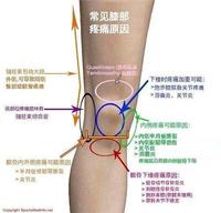 一億中國人都有骨關節炎,怎麼止疼你知道嗎? - 知乎