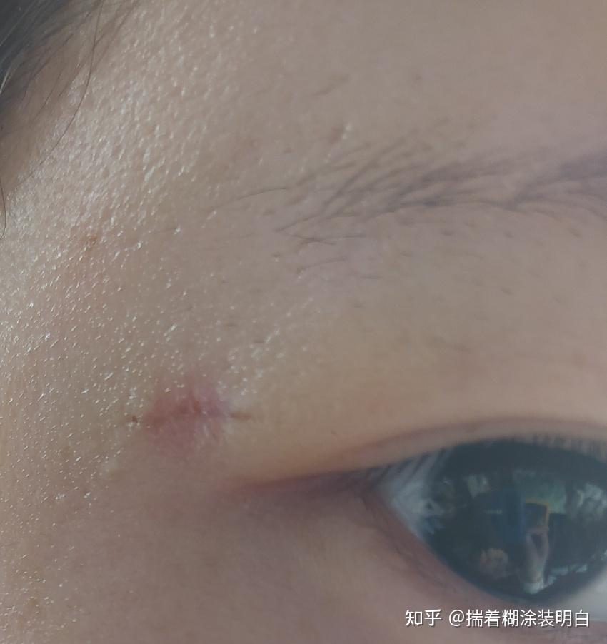 3个多月吧,你们自己算吧,感觉不是一条细线的疤,之前痣的位置现在是