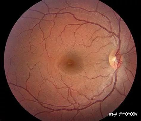 预防近视吃点叶黄素有帮助吗