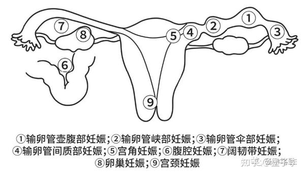 有关宫外孕，你知道多少？ 知乎