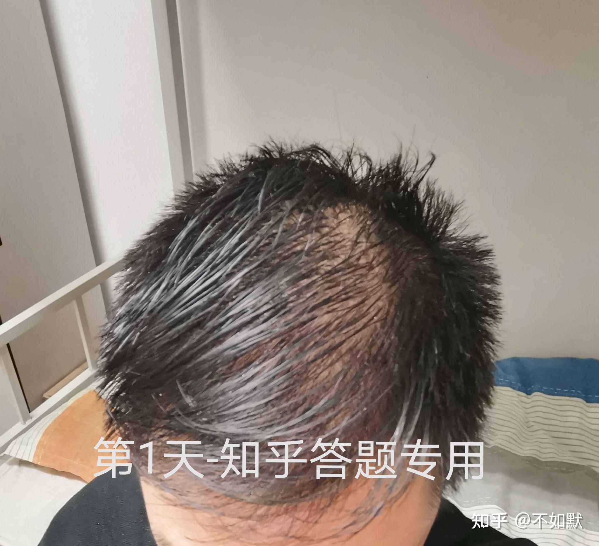 非那雄胺 米诺地尔使用三个月真实效果100天记录贴 - 知乎