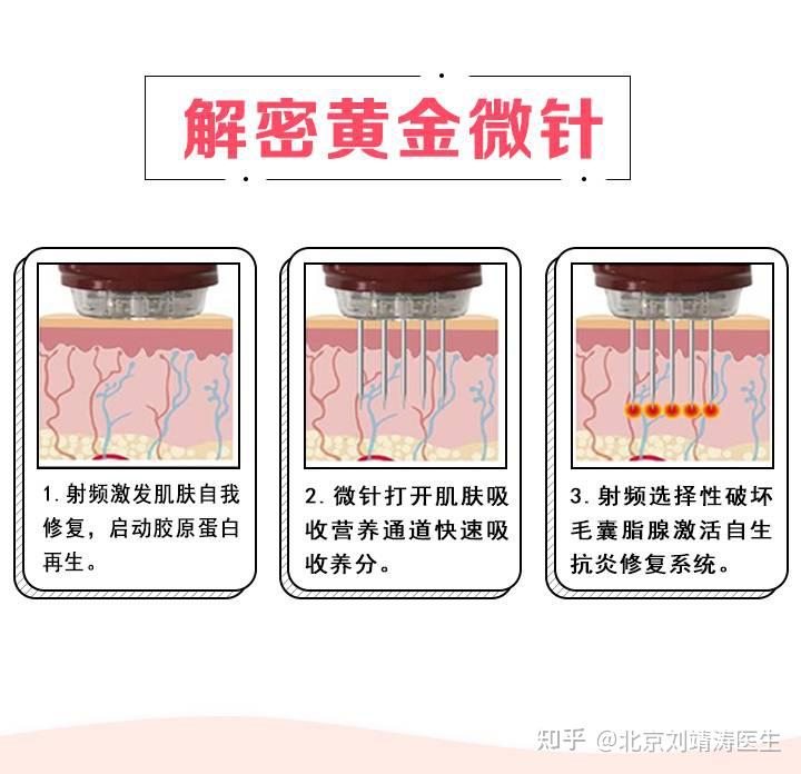 黄金微针和微针有什么区别? - 知乎