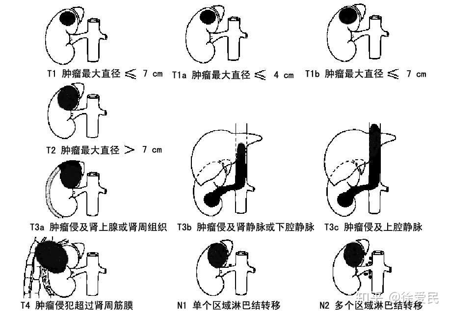 这可能是目前关于肾癌介入治疗最系统最全面的介绍了