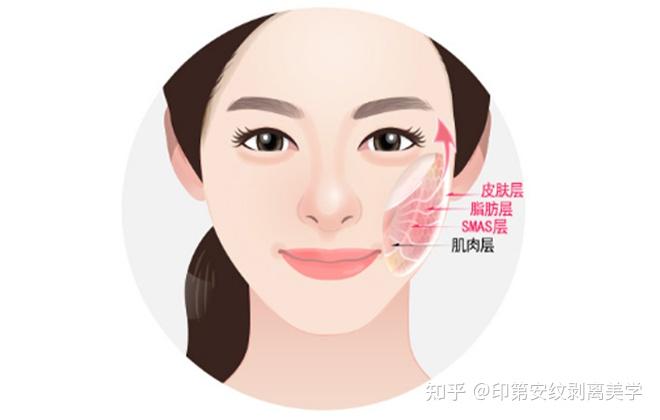 印第安纹剥离效果怎样印第安纹剥离恢复期需要多久