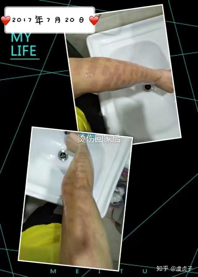 激光脱毛烫伤后