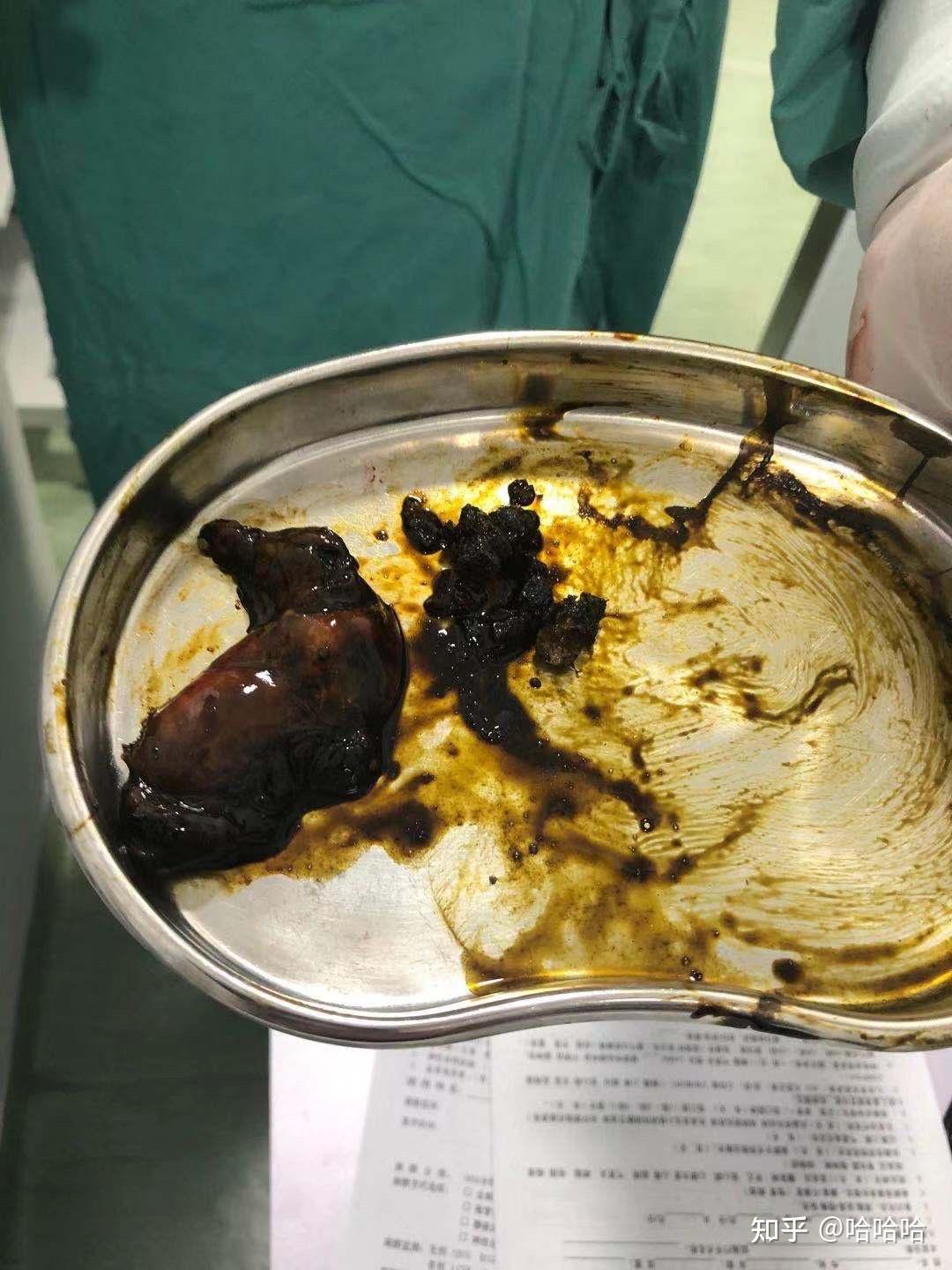 发现胆囊结石到切除的全过程