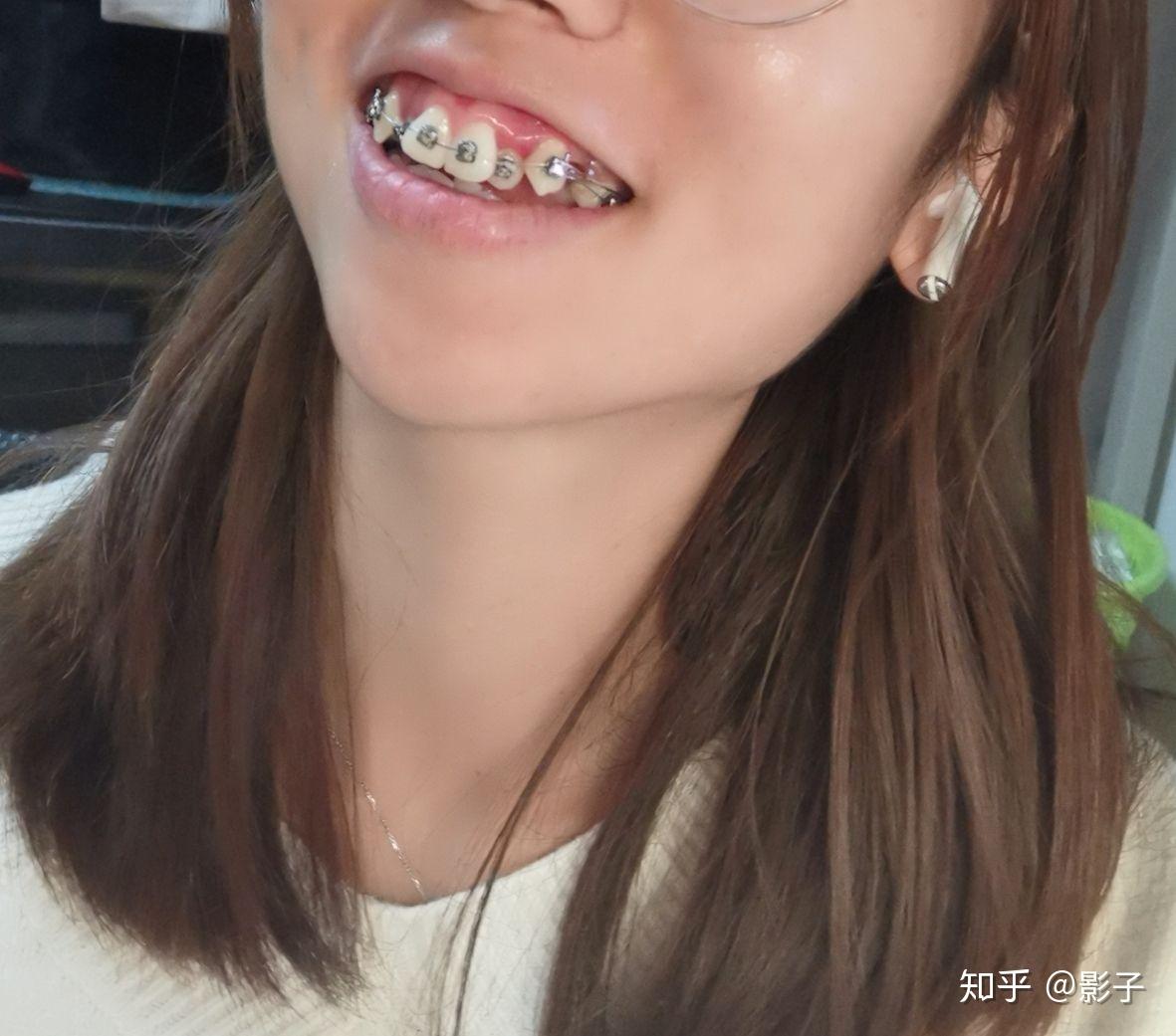 箍牙日记开整 - 知乎