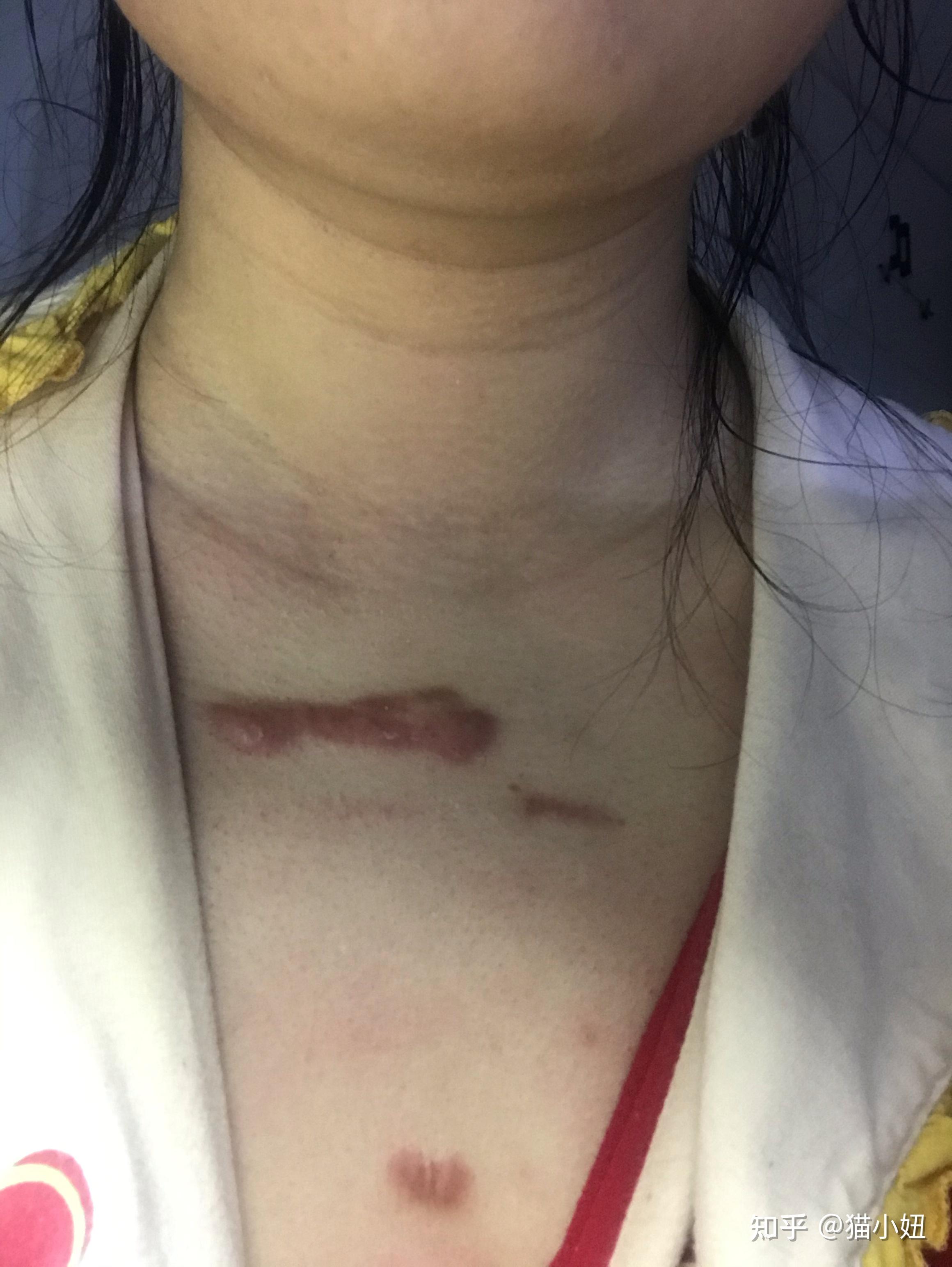 胸疤痕疙瘩怎样治疗图片