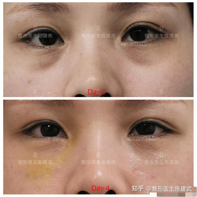 35歲美女眼袋手術4天后淚溝黑眼圈明顯改善