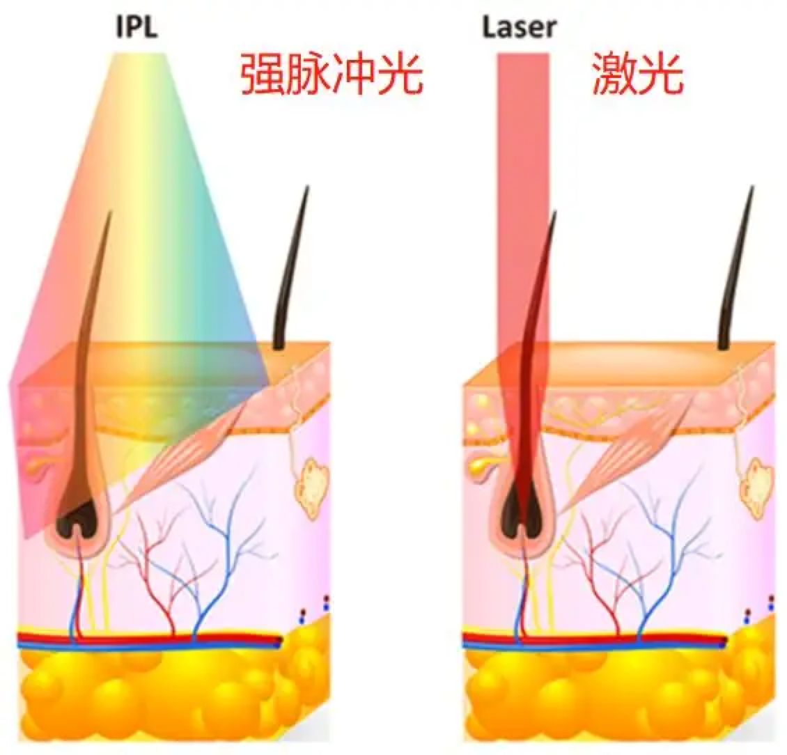 激光脱毛原理图片