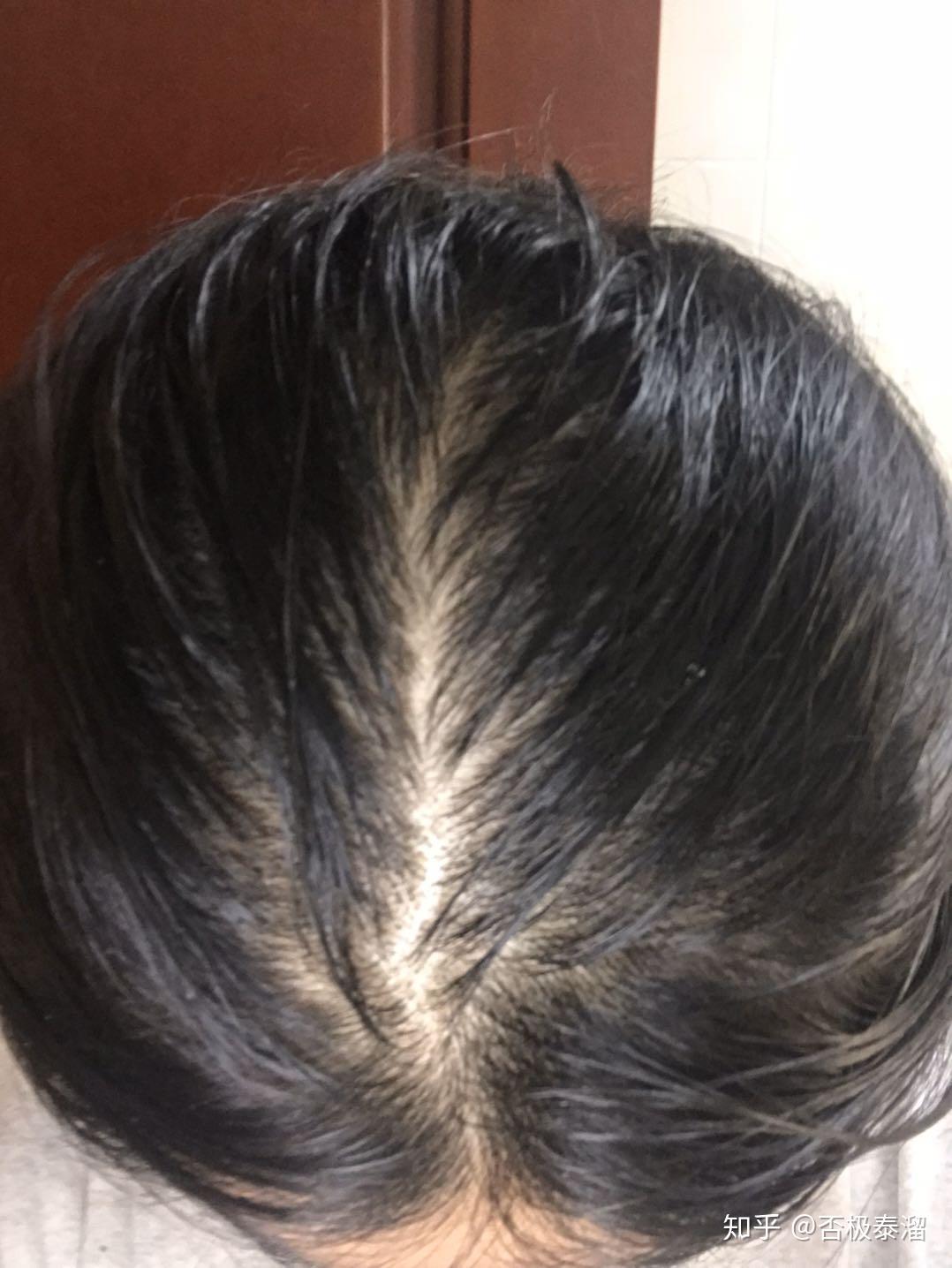 女生发量少头顶快秃了有没有什么好的生发方法跪求