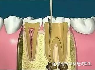 怎么戴牙冠 v2-364bebceba69ed6ef044c6222f5667a5_b.jpg