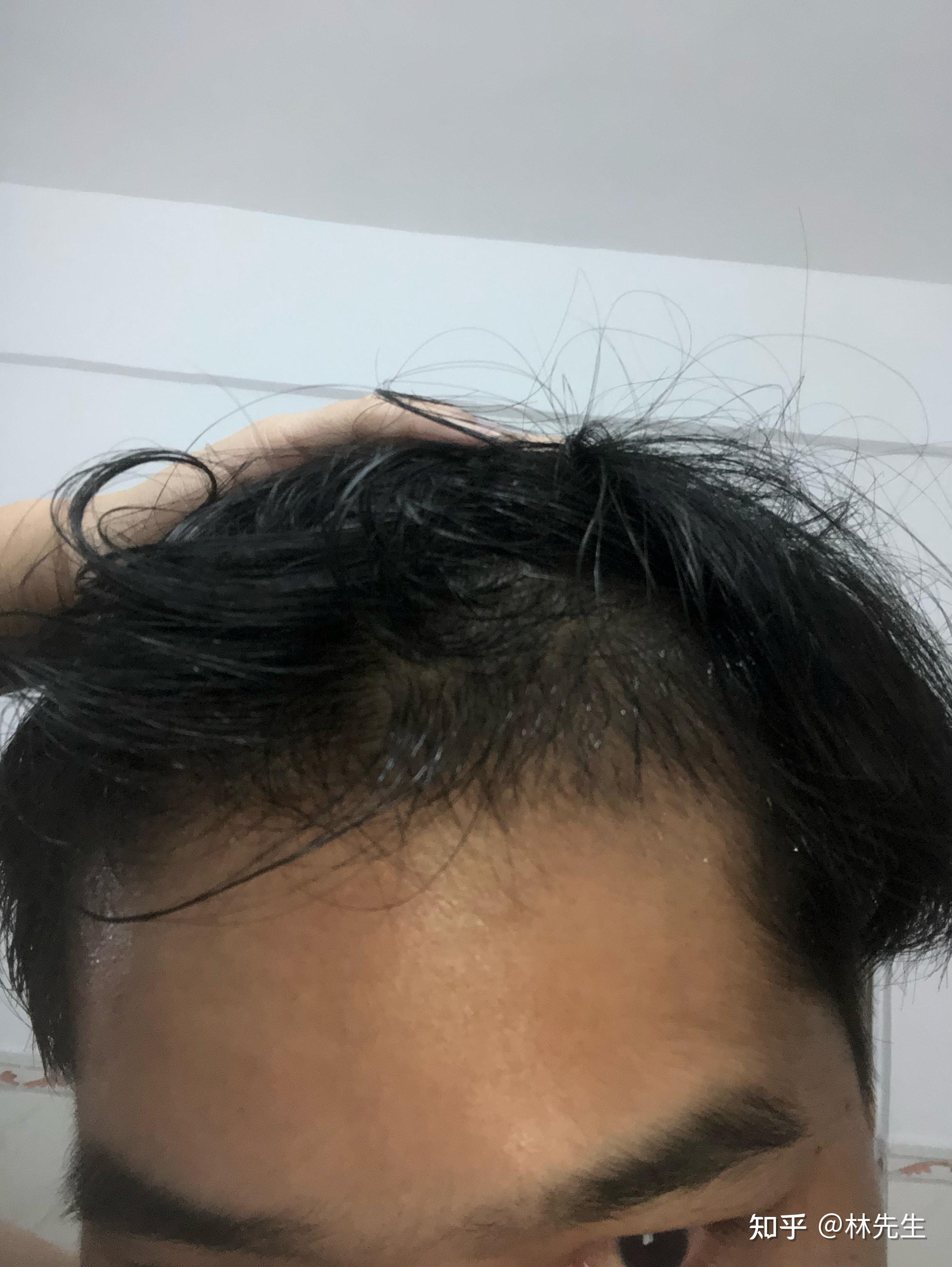 治疗m型脱发,用米诺加非那第三个月