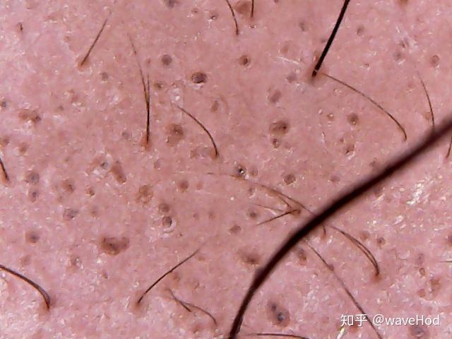 微针生发案例101个月米诺地尔加滚针每周x2