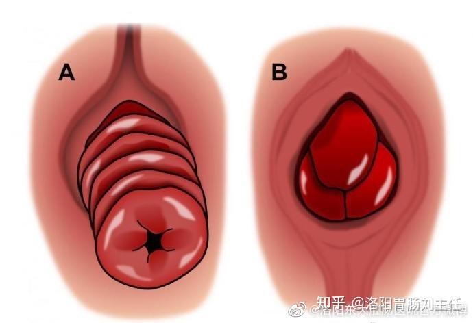 肛门痔疮图 脱肛图片