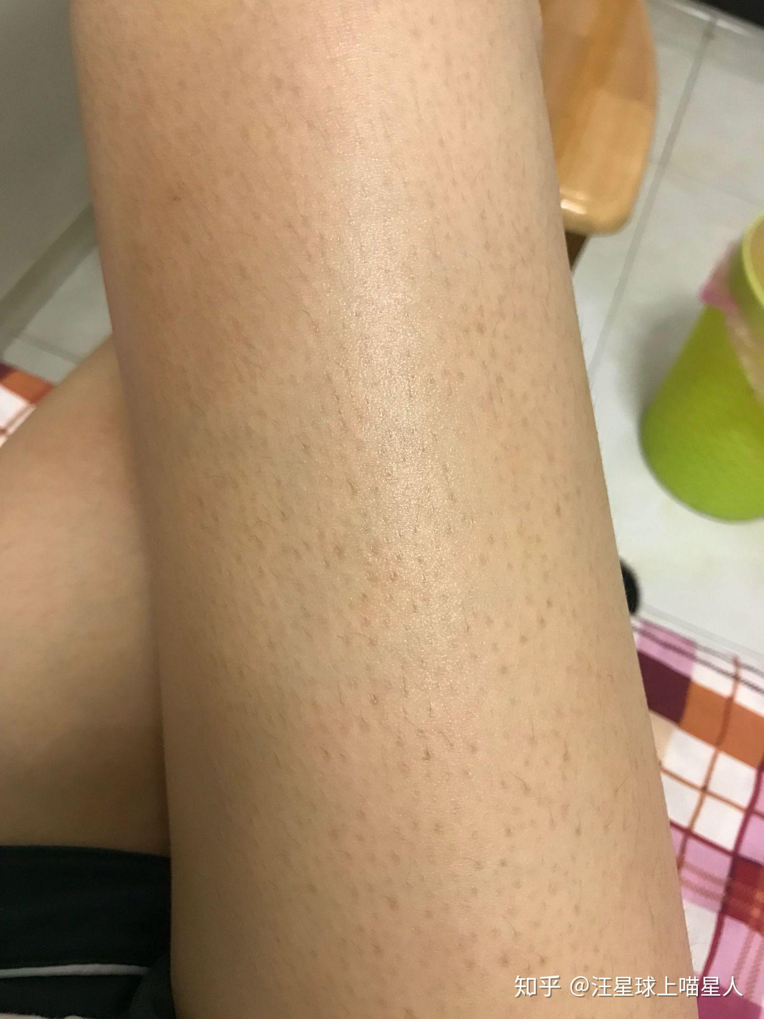 怎么消除鸡皮肤色素(怎么消除鸡皮肤色素沉淀)