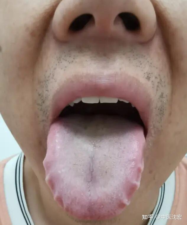 舌红阴虚有热,舌白血虚有寒,舌胖气虚有湿,中医教你从舌象看病