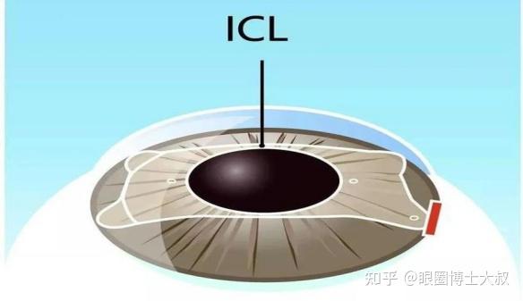 屬於眼內屈光手術的一種,又叫作有晶體眼的人工晶體植入術,這種手術