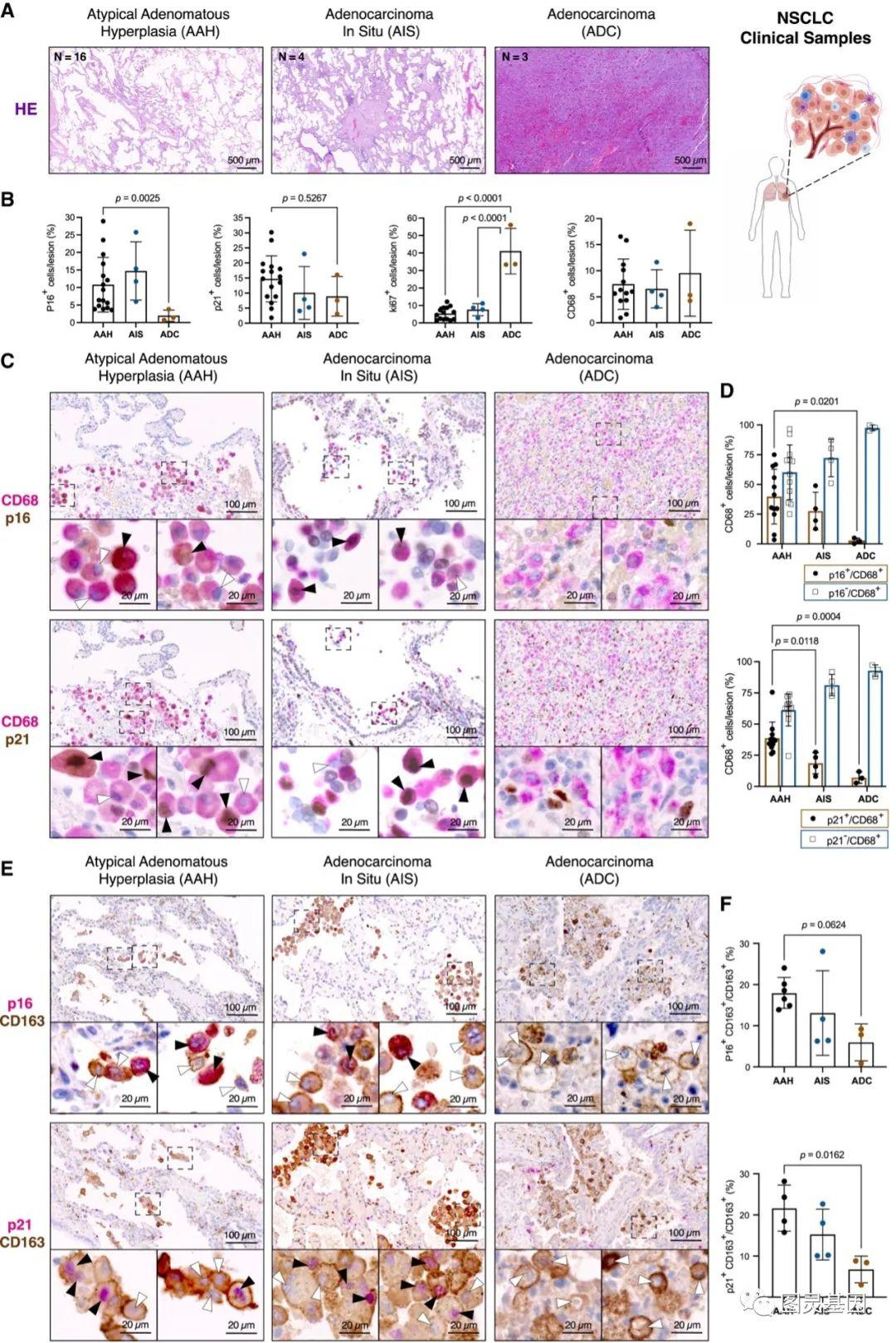 cancercell衰老巨噬细胞清除后显著改善kras驱动的肺癌发生