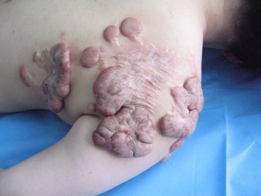 蟹足状肿瘤图片