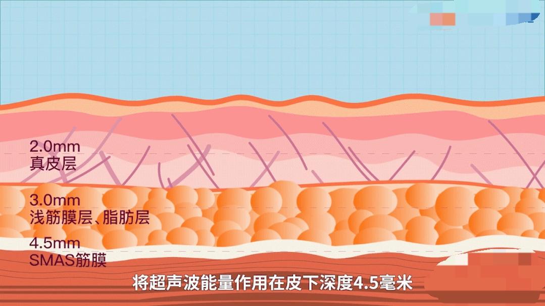 超声刀,还是今天讲的超声炮它们在原理上其实差不多都是向皮肤深层