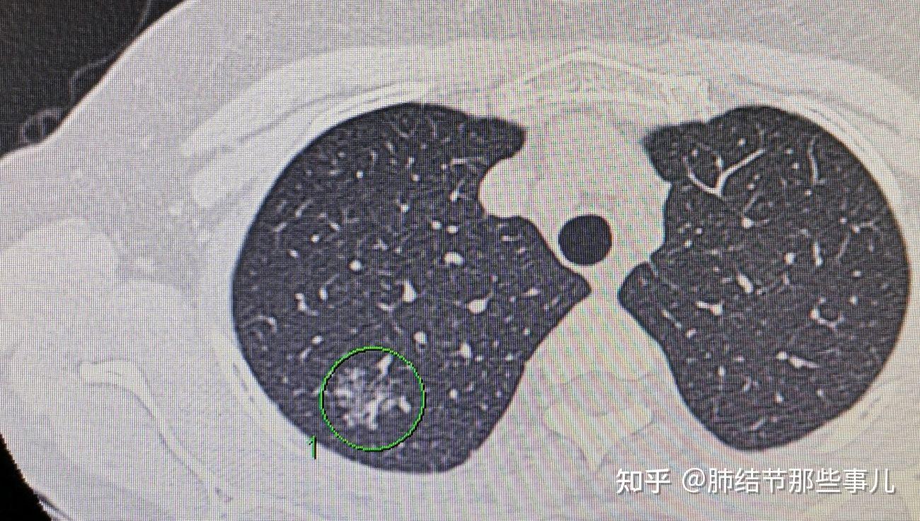 磨玻璃结节型肺癌并不只是纸老虎小心提防肺结节长肉不长个和腾笼换鸟