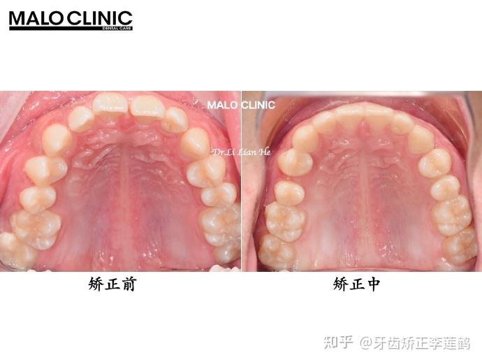 北京牙齒矯正丨深覆合深覆蓋有什麼危害