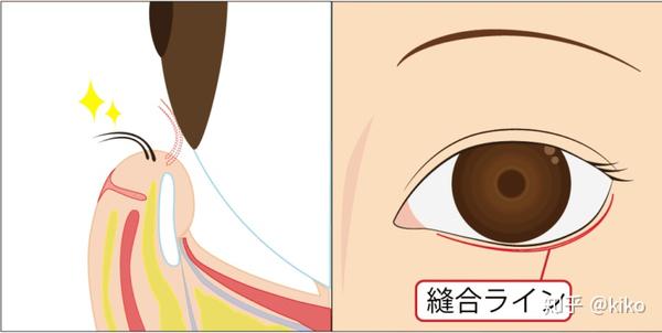 顕微鏡下眼形成手術 = OCULOPLASTIC SURGERY THROUG…-