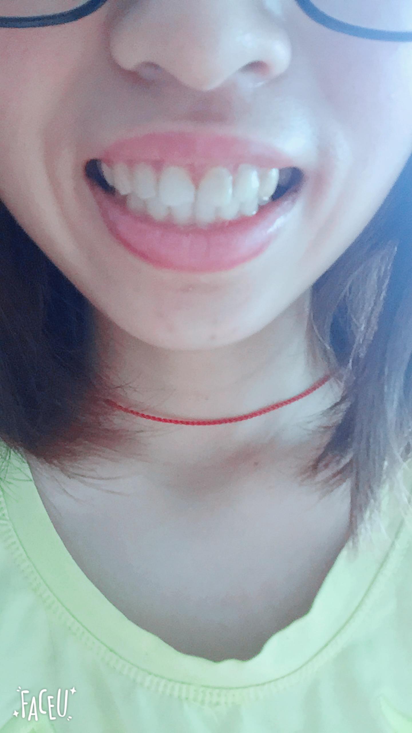 四眼钢牙妹的矫牙日记