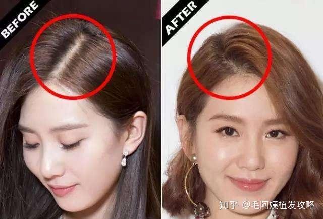 如果发现新的分发线一样很宽很明显,那就表示整个头顶部头发的密度都