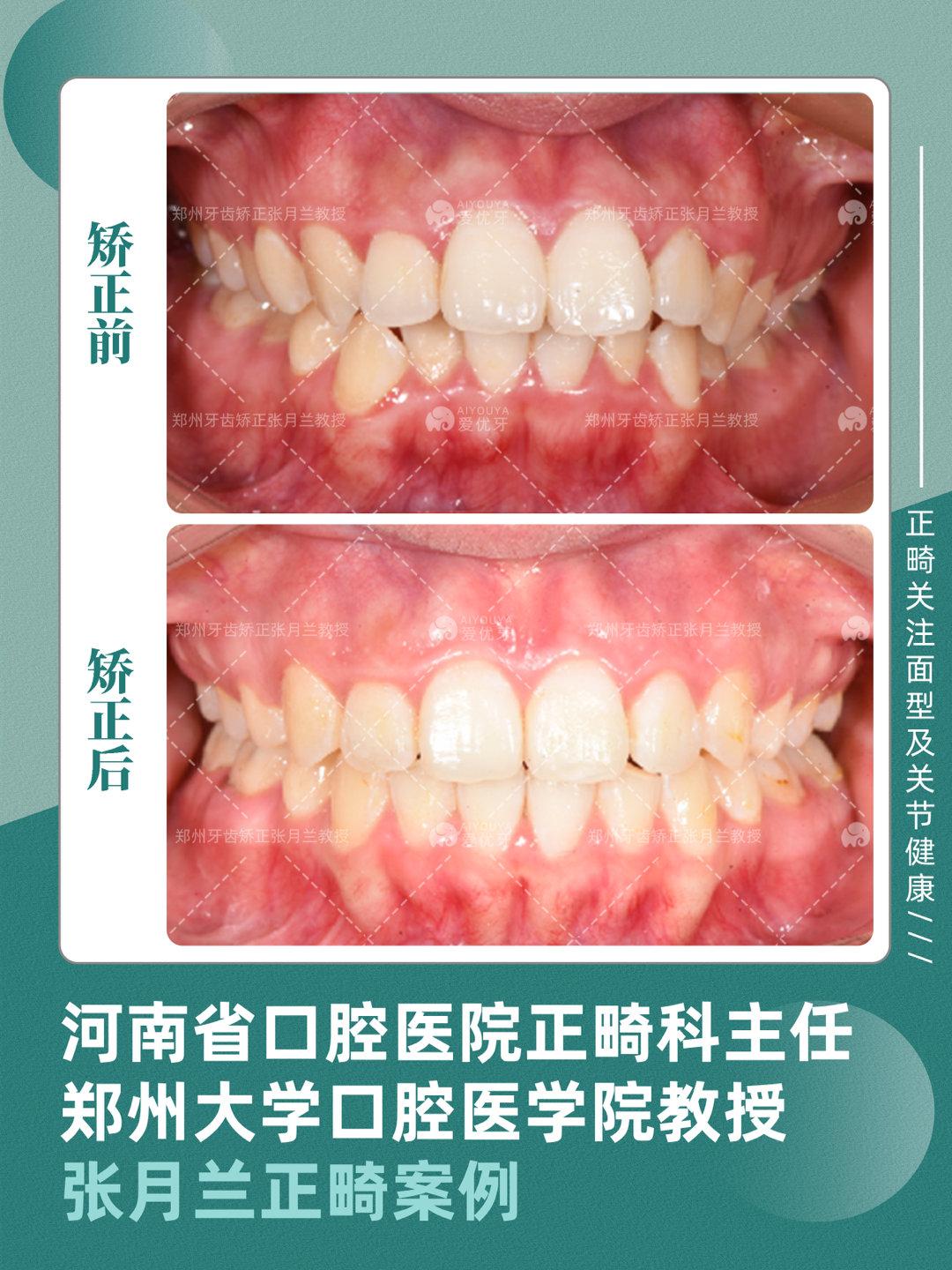 北京牙齿矫正 | 严重骨性地包天、嘴凸下巴后缩、牙齿矫正堪比整容！ - 知乎