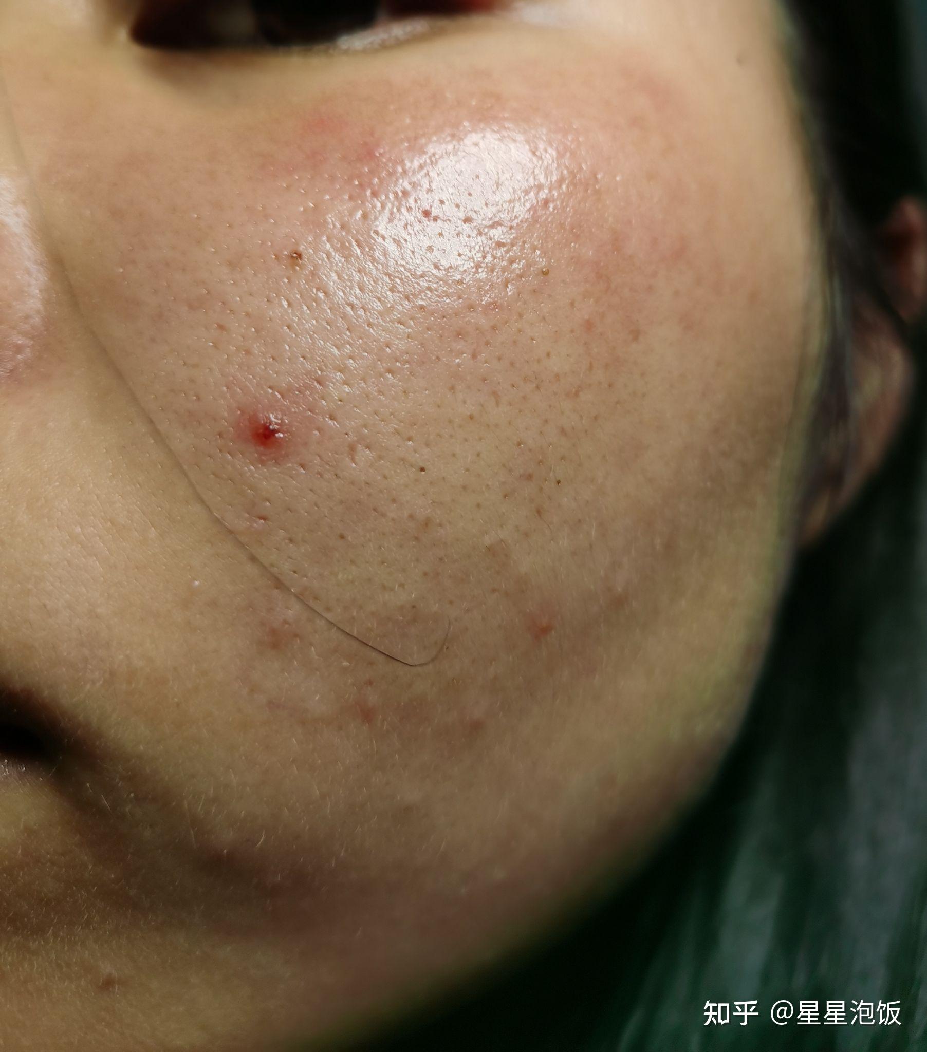 敏感肌激素脸玫瑰糠疹