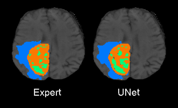 Attention unet. UNET нейронная сеть. Сегментация изображений компьютерное зрение. UNET Segmentation. UNET Architecture.