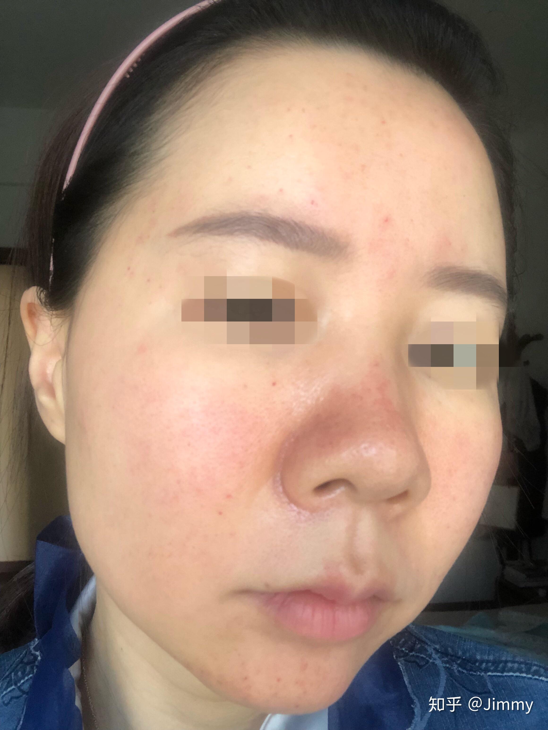 韩国露飞ruffy婴儿针