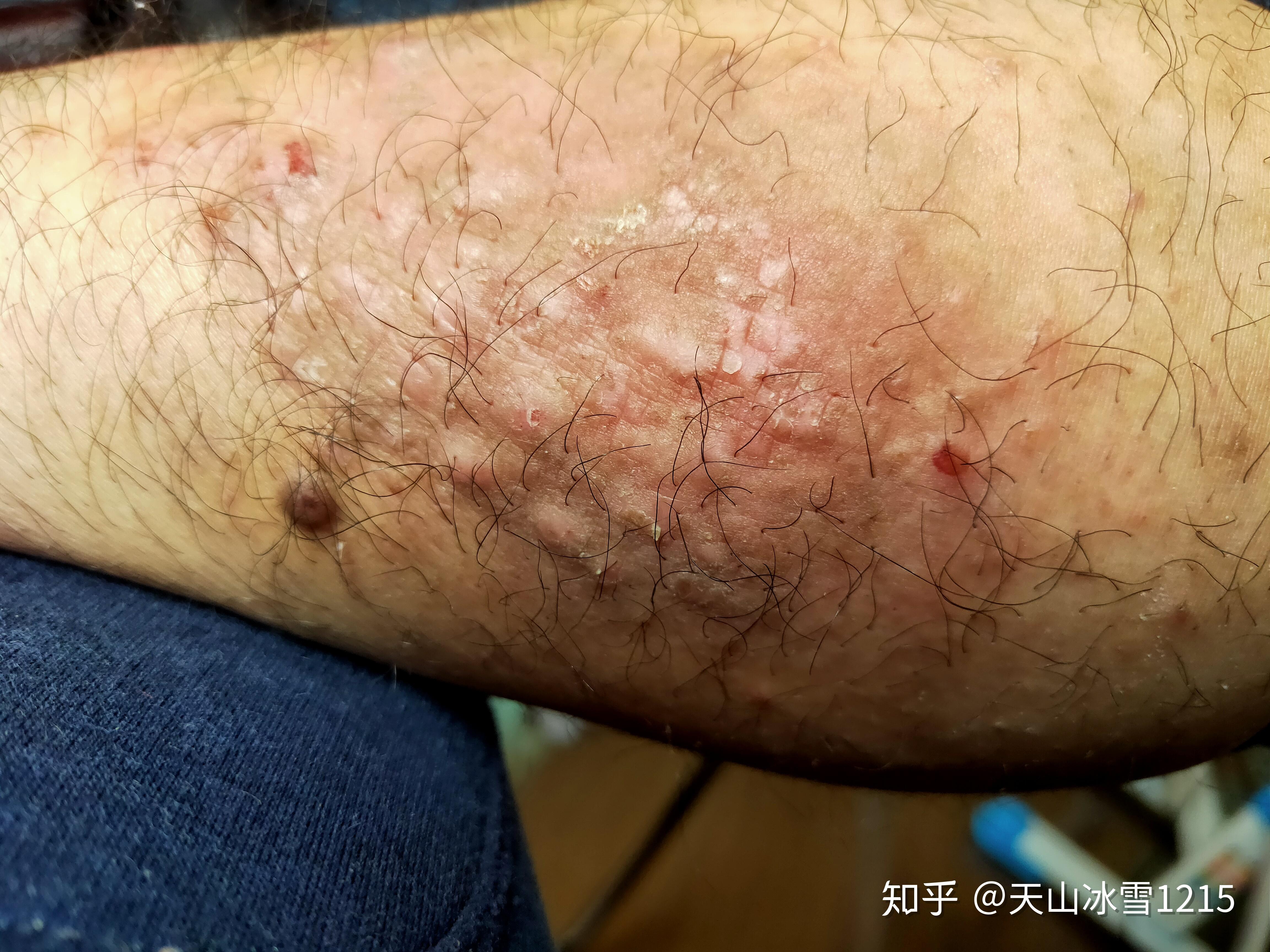 十一年湿疹有望治愈感谢神奇的中医秘方图文连载持续更新治疗效果4