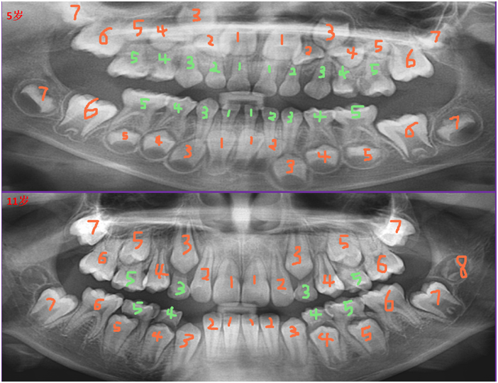 乳牙根管数量形态图片