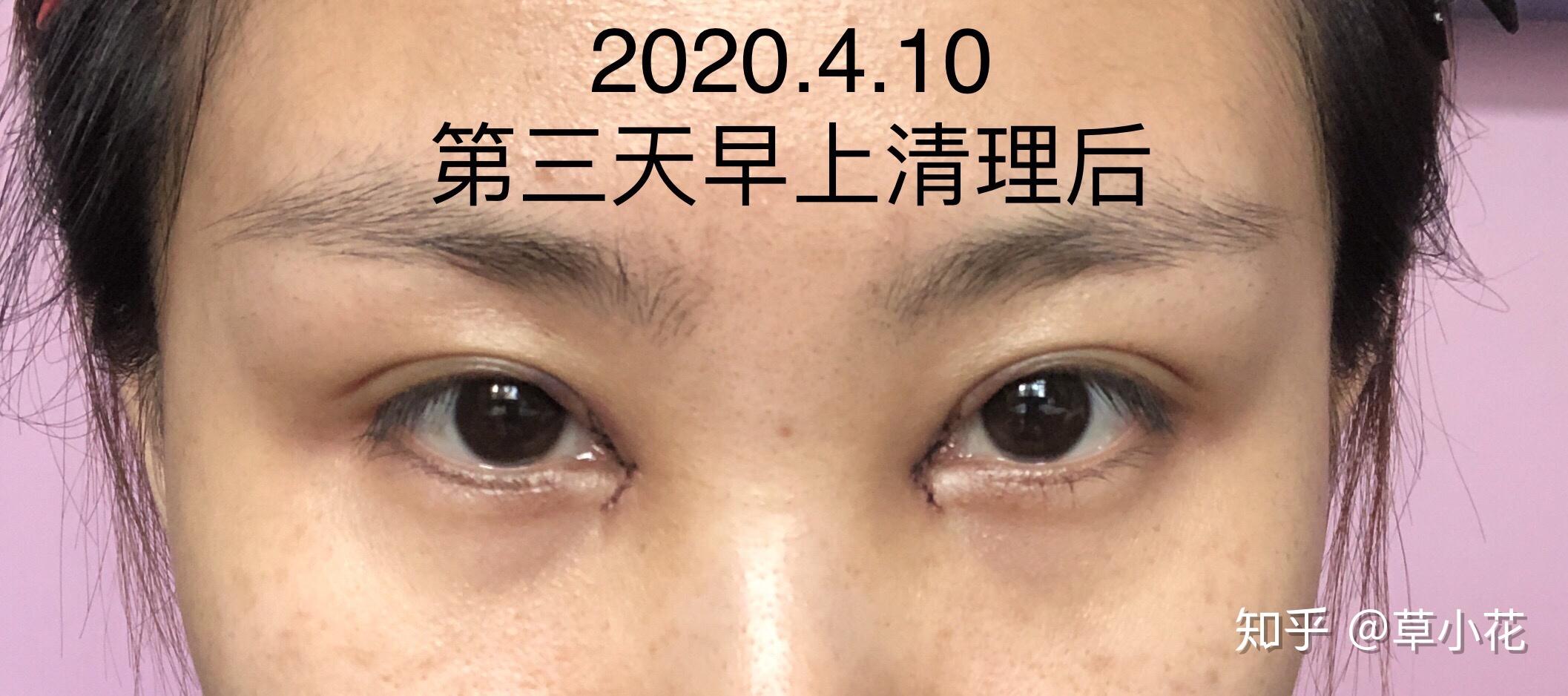 开眼角内眦赘皮记录95 - 知乎