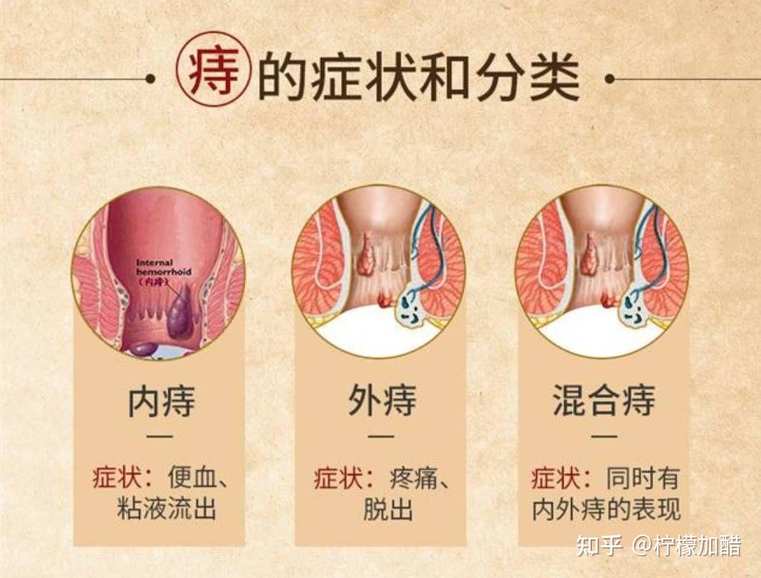 痔疮栓图解图片