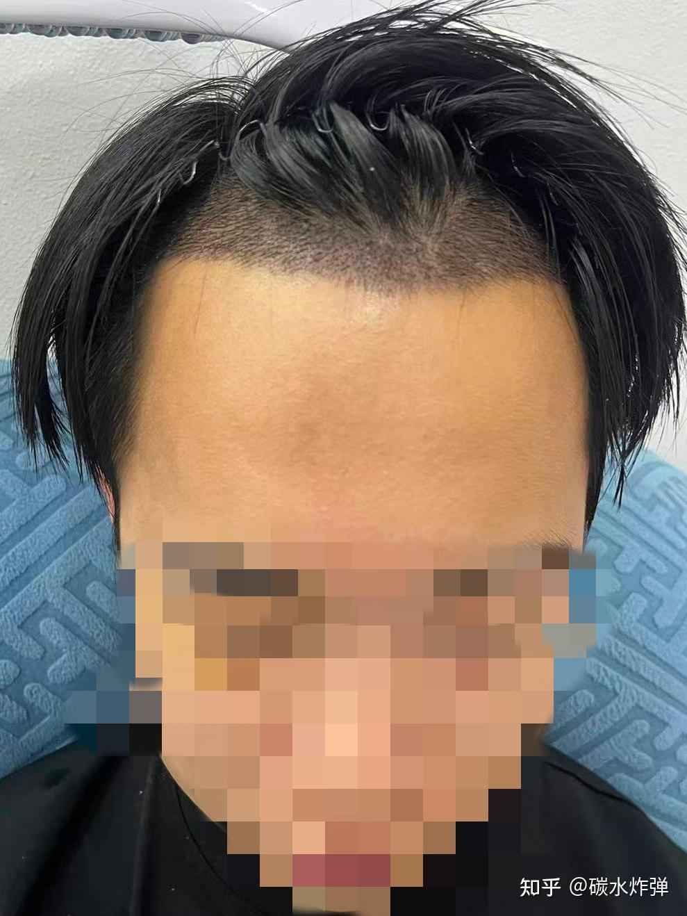 2045 单位剃发植发，5 天！男生发际线终于不 “后移” 了 - 知乎