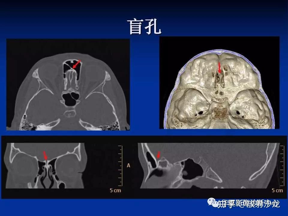 高分辨率ct的密度和空間分辨率均得到很大的提高,對顱底骨性微細結構