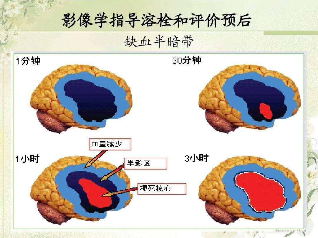 icu第一中单浅谈脑梗死