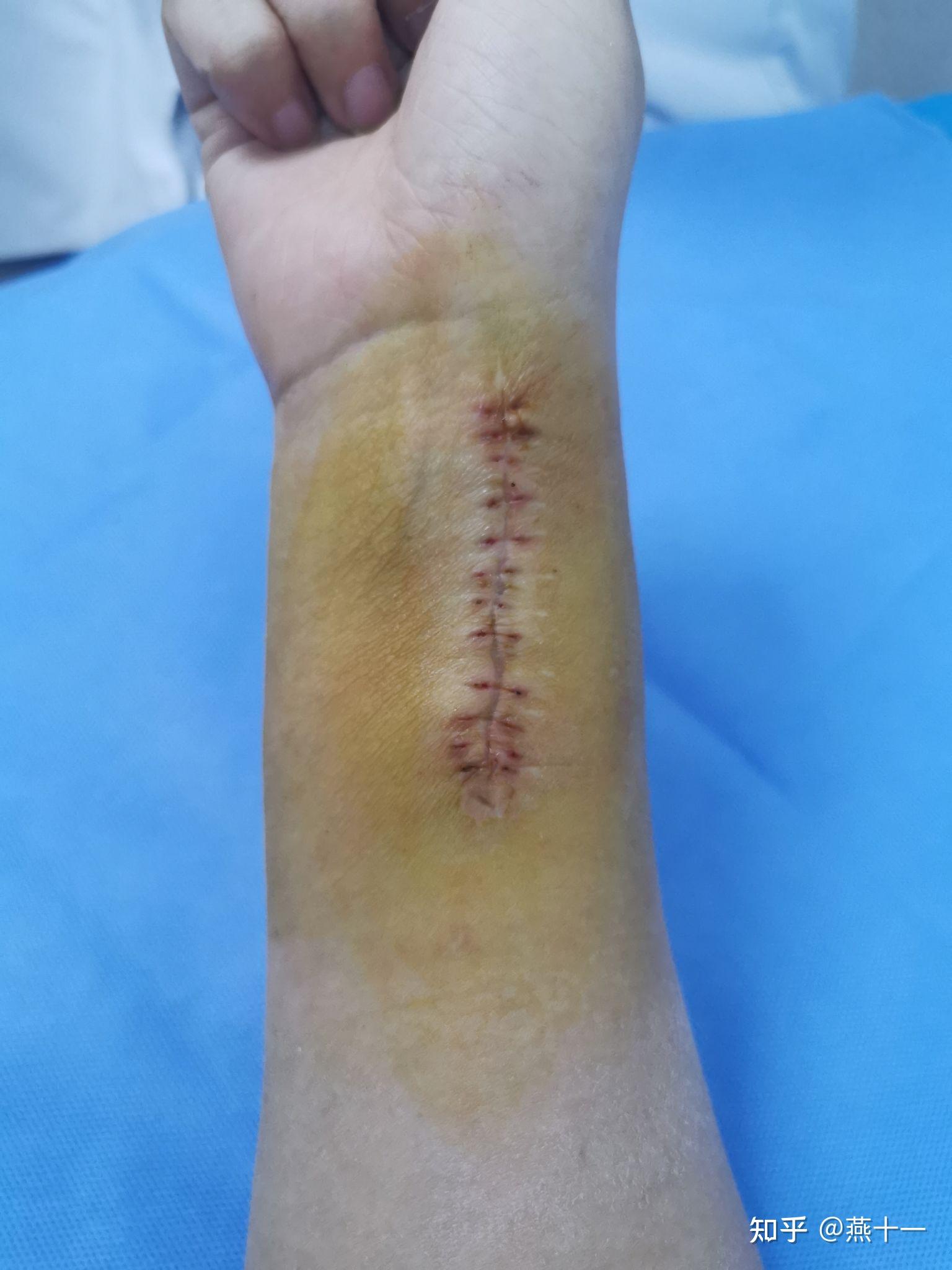 写个手腕粉碎性骨折康复吧(更新拆钢板啦)