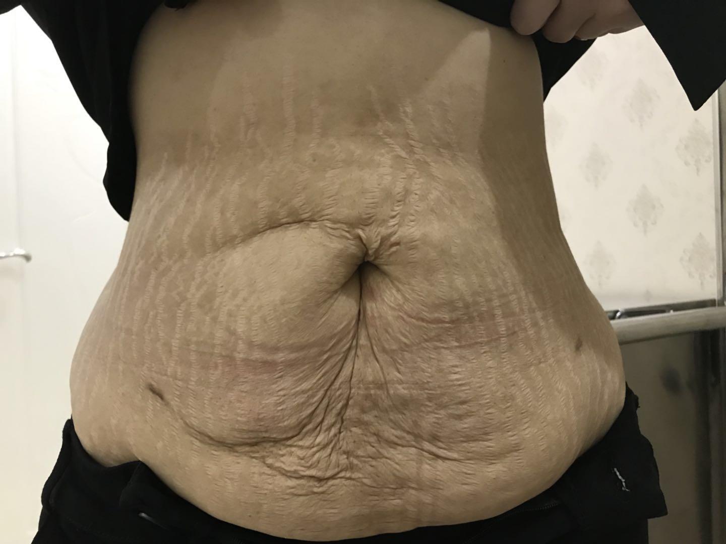 产后肚皮松弛 皮肤失去弹性 腹壁整形改善效果怎么样 知乎 产后肚皮松弛 皮肤失去弹性 腹壁整形改善效果怎么样 知乎