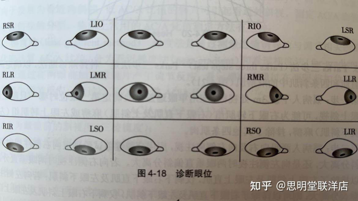 您了解什么是斜视和有哪些斜视分类吗?
