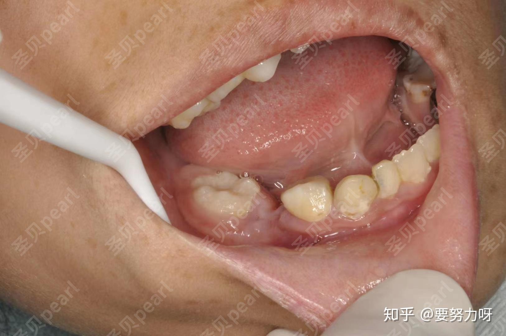 北京聖貝口腔案例分享乳牙早脫為什麼需要戴間歇保持器