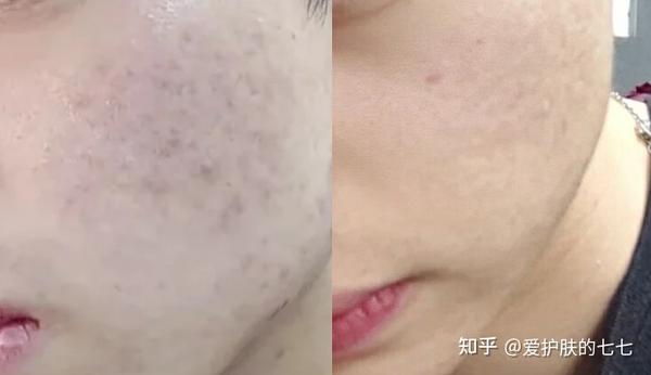 男生满脸痘印究竟怎样才能去掉?皮肤科医生教你科室专用去痘印方法,一个月把痘印去干净!4步搞定! - 知乎