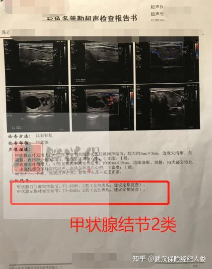 核保案例甲状腺结节4级由拒保到除外承保