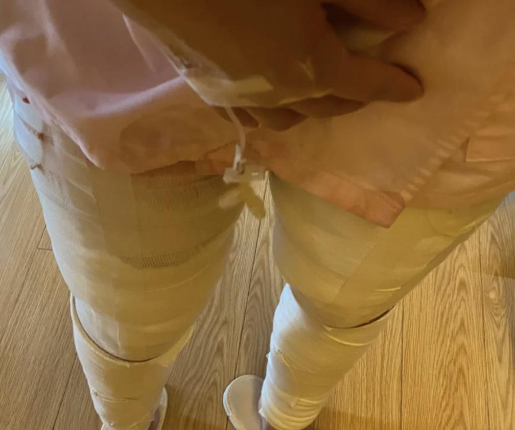 大腿抽脂修复真实经历分享