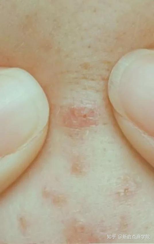 皮肤组织被破坏得也越深,而青春痘发作时的发炎反应越严重造成了皮下